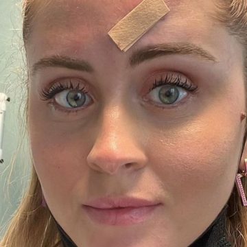 Valentina Ferragni, brufolo sospetto tolto dal viso: “Era un tumore”
