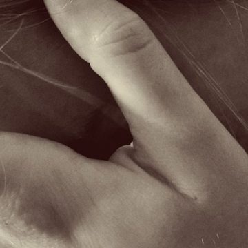 Donna sfregiata con acido Donna sfregiata con acido