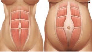 Diastasi addominale