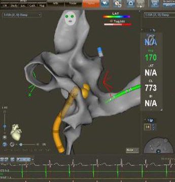 Ospedale Mauriziano di Torino, per la prima volta al mondo ablazione fibrillazione atriale senza raggi X